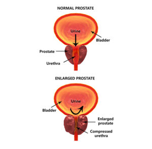 Tur Defect Prostate Relief with Transformative TURP Procedure